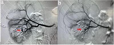 Superselective Renal Artery Embolization Management of Post-percutaneous Nephrolithotomy Hemorrhage and Its Methods